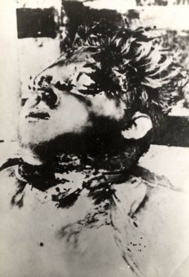 child-mutilated Croatia WW II
